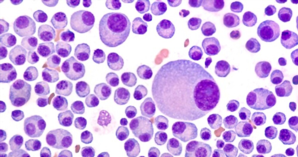 Role of bone marrow transplant in multiple myeloma Treatment